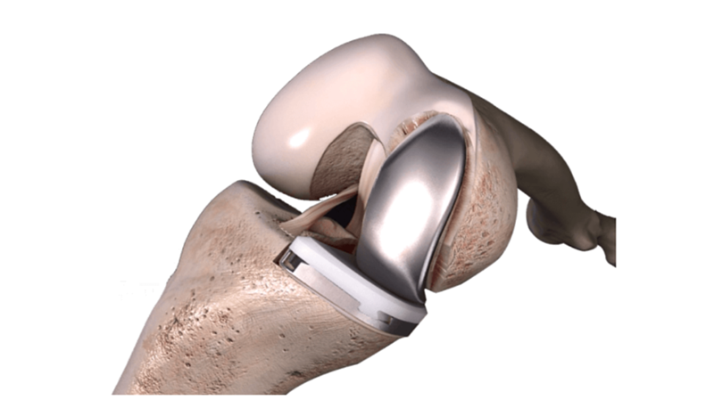 SIGMA™ HP Partial Knee